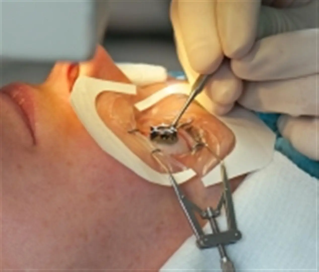 Cornea Transplant Surgery India – Best Organ Transplant Hospital